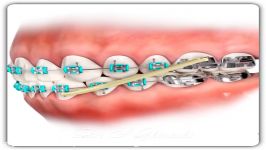 الاستیک های ارتودنسی  دکتر سعید قریشی