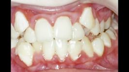 ارتودنسی بدون کشیدن دندان عکس قبل بعد  دکتر داوودیان