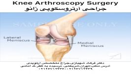 کلیپ پزشکی جراحی آرتروسکوپی زانو،دکتر شهبازی،پزشک جراح متخصص ارتوپدی ۲۶۷۱۲۴۳۶