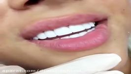 لبخند هالیوودی دکترمجیدقیاسی دندانپزشک زیبایی مشهد