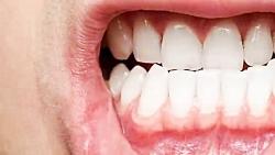 علت حساس شدن دندان ها چیست؟