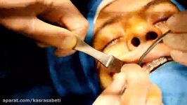 جراحی پروتز گونه جراحی بینی به صورت همزمان