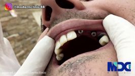 ویدیو تحویل روکش ایمپلنت کلینیک دندانپزشکی مدرن