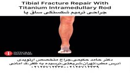 کلیپ پزشکی جراحی شکستگی ساق پا،دکتر حامد حکیمی،پزشک جراح متخصص ارتوپدی 26712439