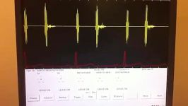صداهای قلبی  رگورژتاسیون نارسایی دریچه آئورتی