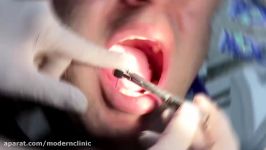 کاشت ایمپلنت کلینیک دندانپزشکی مدرن