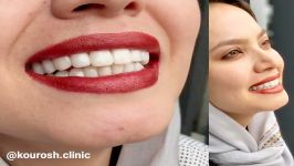 کامپوزیت دندان در مشهد  کلینیک دندانپزشکی کوروش