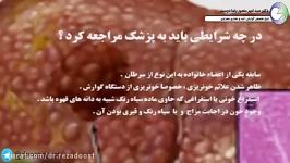 سرطان کبد Liver Cancer