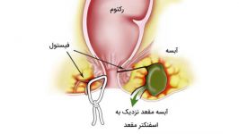 جراحی فیستول ببین شاید روزی به کارت بیاد...