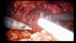 perclotresponder powder in radical prostatectomy