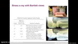 Dr. Björn Barenius  PRESENTATION 2019 PCL Injuries and Reconstruction