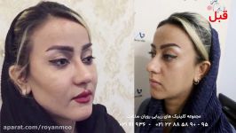 فیلم قبل بعد تزریق چربی به صورت  کلینیک رویان سلامت