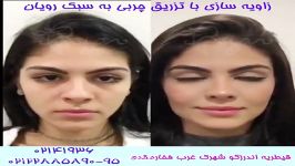 فیلم قبل بعد تزریق چربی به صورت کلینیک رویان سلامت