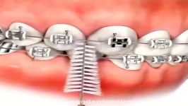 مسواک ارتودنسی  مسواک بین دندانی  کلینیک دندانپزشکی درسان