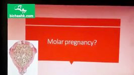 حاملگی پوچ یا مولار چیست چه علائمی دارد ؟  مجله پزشکی بیچشک