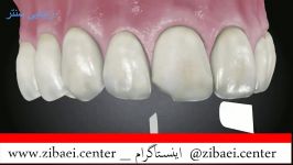کامپوزیت دندانپر کردن دندان یا روکش دندانداندان پزشکی در زیبایی سنتر