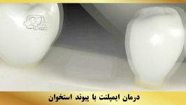 درمان ایمپلنت پیوند استخوان  دندانپزشکی سیمادنت