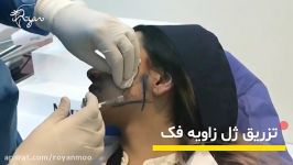 زاویه سازی فرم دهی فک تزریق ژل کلینیک رویان سلامت