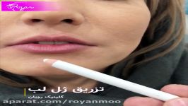 تزریق ژل لب هیالورونیک اسید حجم فرم دهی لب  کلینیک رویان سلامت