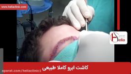 کاشت ابرو  فیلم کاشت ابرو  کلینیک پوست مو هلیا  شماره 8