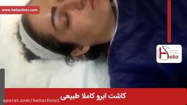 کاشت ابرو  فیلم کاشت ابرو  کلینیک پوست مو هلیا  شماره 9