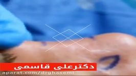 فیلم ❌تزريق فيلر به بينى❌ بدون نياز به جراحى بيهوشى