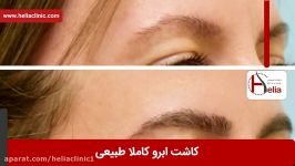 کاشت ابرو  فیلم کاشت ابرو  کلینیک پوست مو هلیا  شماره 11