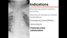 Catheterization