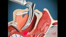 Intubation