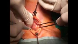 Trachiastomy Procedure