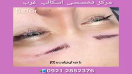 میکروبلیدینگ ابرومیکروشیدینگفیبروز