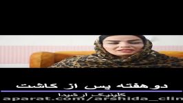 فیلم کاشت ابرو دائم  کلینیک آرشیدا