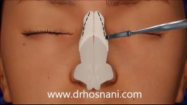 Rhinoplasty animation