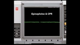 Asystole EKG