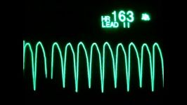 Cardiac Arrest ECG