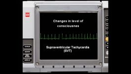 supraventricular tachycardia EKG