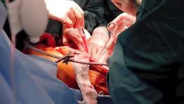 iTube 15586925 Liver Transplant Surgery Dr. Mark Ghobri