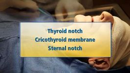 Surgical Cricothyroidotomy