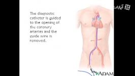 Directional coronary atherectomy DCA