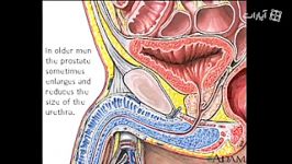 Enlarged prostate gland