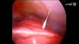 Hydatid Cyst Excision from Liver