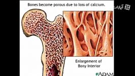 Osteoporosis