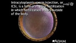 Intracytoplasmic sperm injection