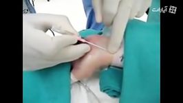 Arterial Line Insertion