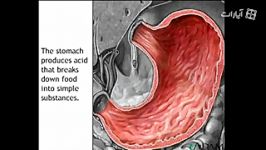 Stomach ulcer