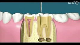 چه جوری دندونات پر میشه؟