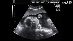 سونوگرافی سه بعدی زیباترین جنین بنام برسام مقدم