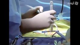 coflex surgery for spinal stenosis