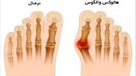 درمان باور نکردنی انحراف قوزک انگشت شست پا