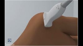 دکتر باقرزادی 3d Ultrasound Guided Shoulder injection